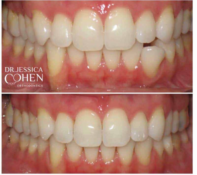 Smile before and after orthodontic treatment for crooked teeth