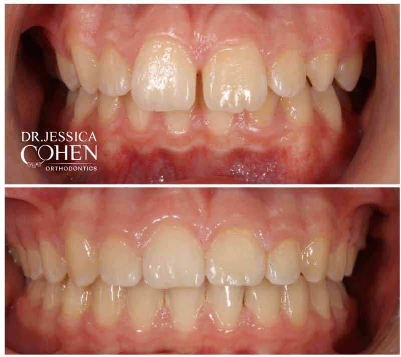 Smile before and after orthodontic treatment for unvenly spaced teeth