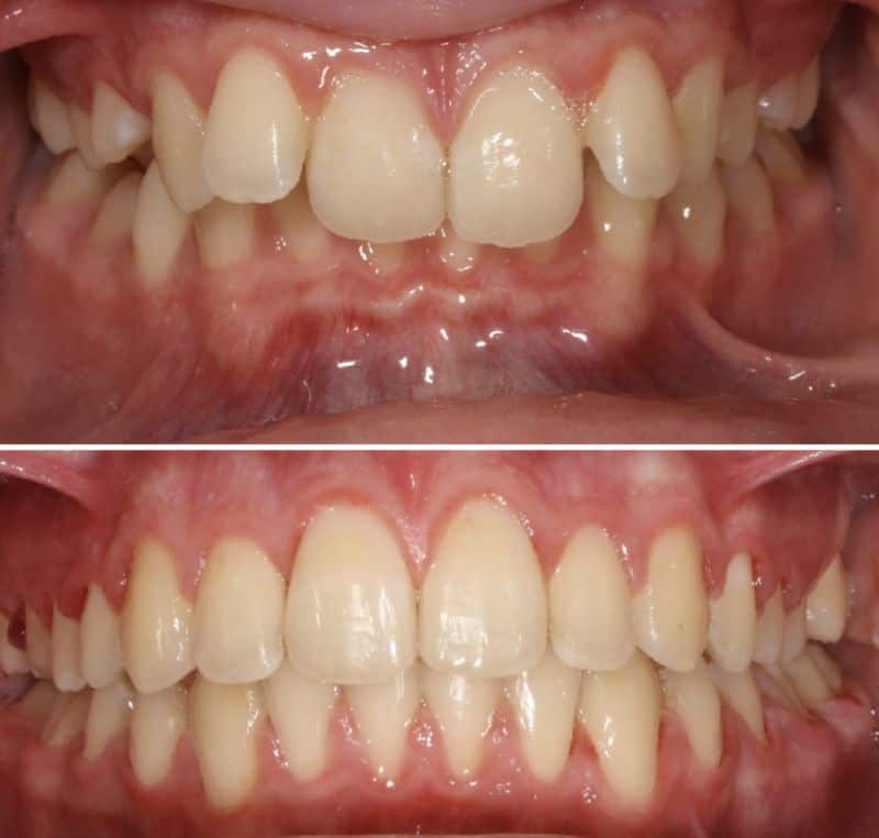 Smile before and after orthodontic treatment for misaligned bite