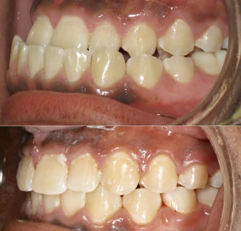 Smile before and after orthodontic treatment for crossbite