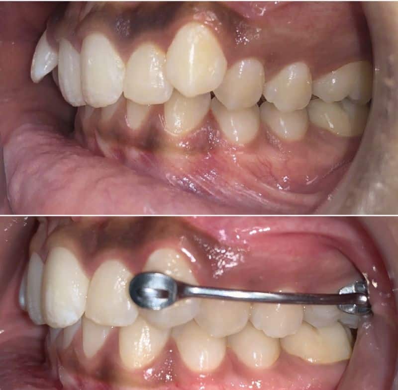 Smile before and during orthodontic treatment for overbite