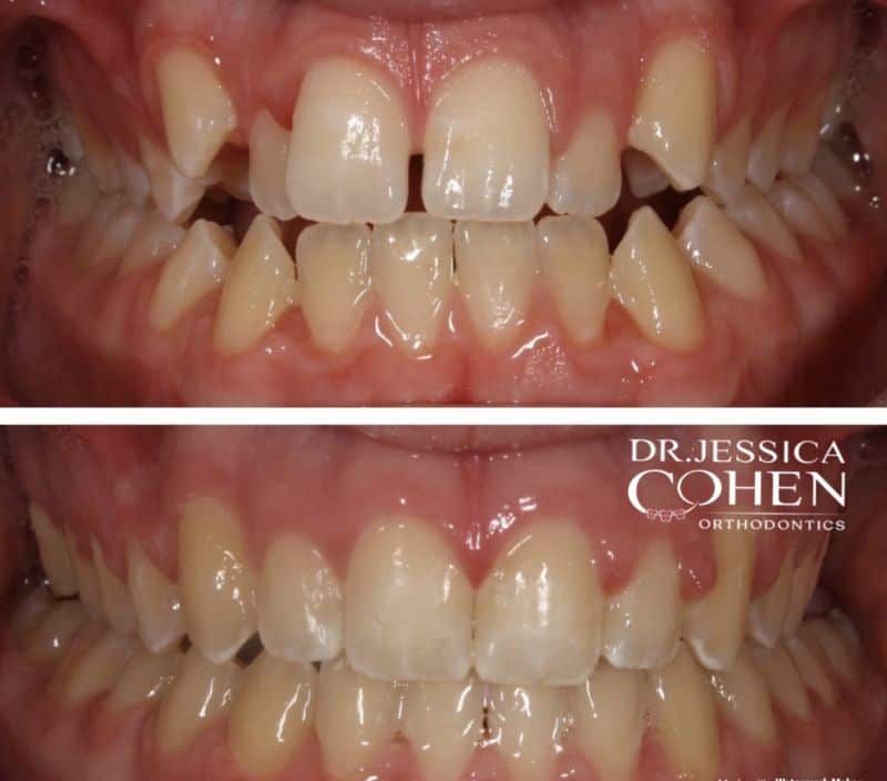 Smile before and after orthodontic treatment for open bite