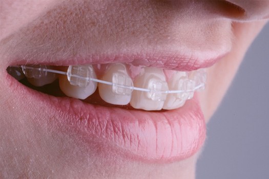 Closeup of clear/ceramic braces