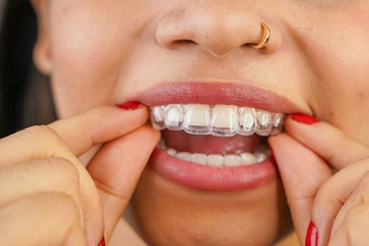 Teen putting in clear aligners