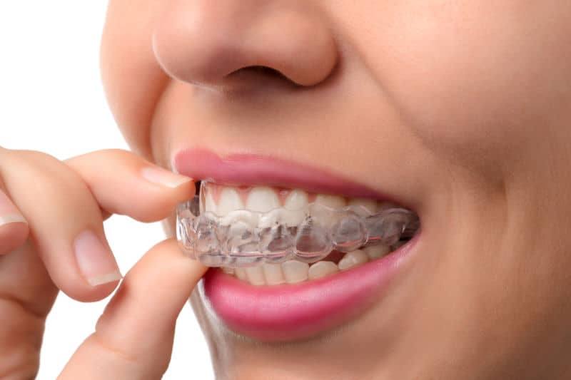 woman putting invisalign onto teeth