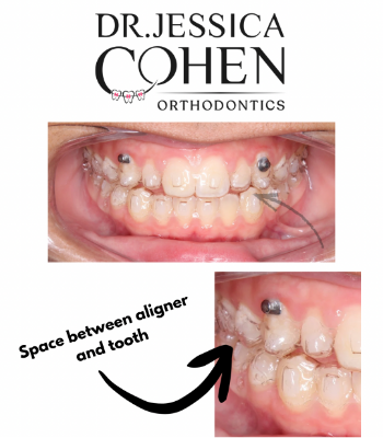Close up of a mouth wearing clear aligners with a gap between the aligner and the teeth