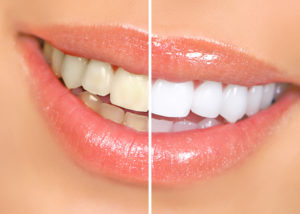 closeup of beautiful smile after professional take-home teeth whitening in Highland Park