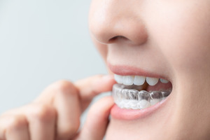 Close-up of woman putting Invisalign aligner on lower teeth