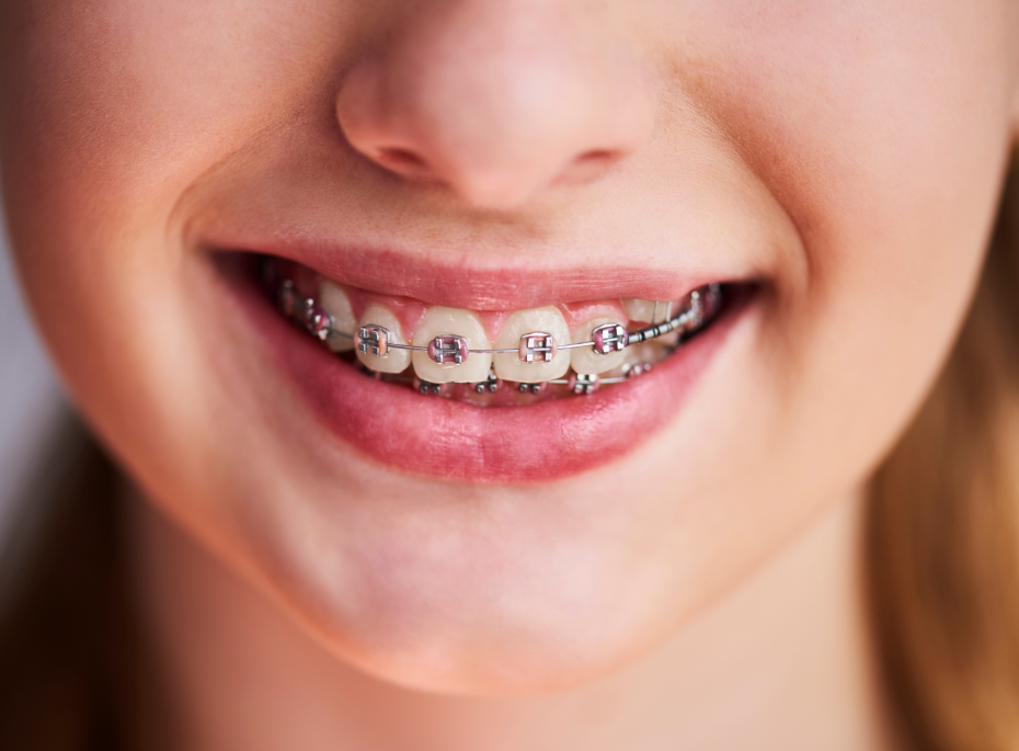 Close up of girl's braces