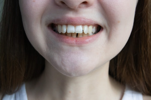 Close-up of woman with an overbite